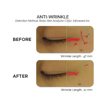 Exoderm wrinkle results visual